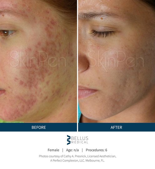 Skin Pen acne scars microneedling v2 jpg 540x540 q85